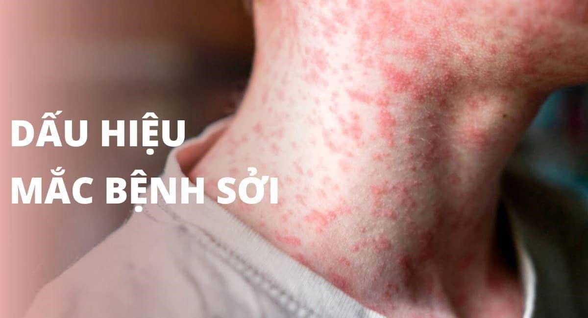 Sởi tấn công, gây tử vong ở người lớn