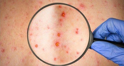 BỆNH SỞI – NHỮNG ĐIỀU CẦN BIẾT